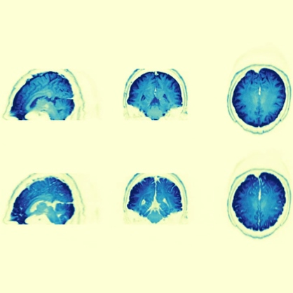 Diffusion Tensor Imaging